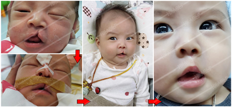 兔唇原來可以補得好靚! - 香港兔唇裂顎協會 Hong Kong Association for Cleft Lip & Palate